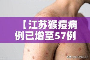 【江苏猴痘病例已增至57例/江苏猴痘病例已增至57例了吗】