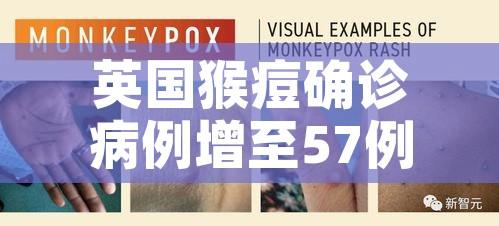 英国猴痘确诊病例增至57例/美国出现猴痘病毒
